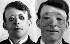 Walter Yeo, uma das primeiras pessoas a passar por um transplante de pele e cirurgia plástica avançada em 1917.